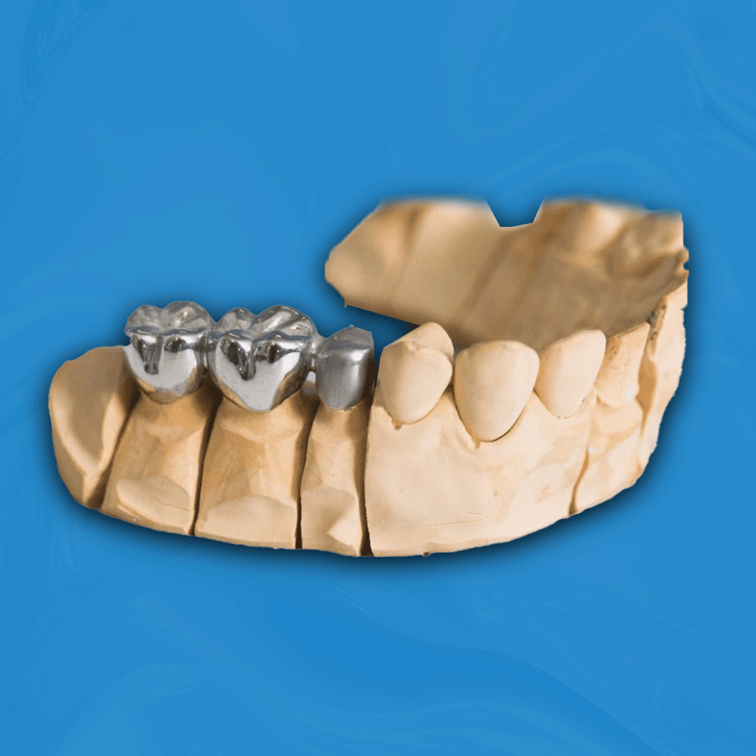 Full Metal Crown and Bridge
