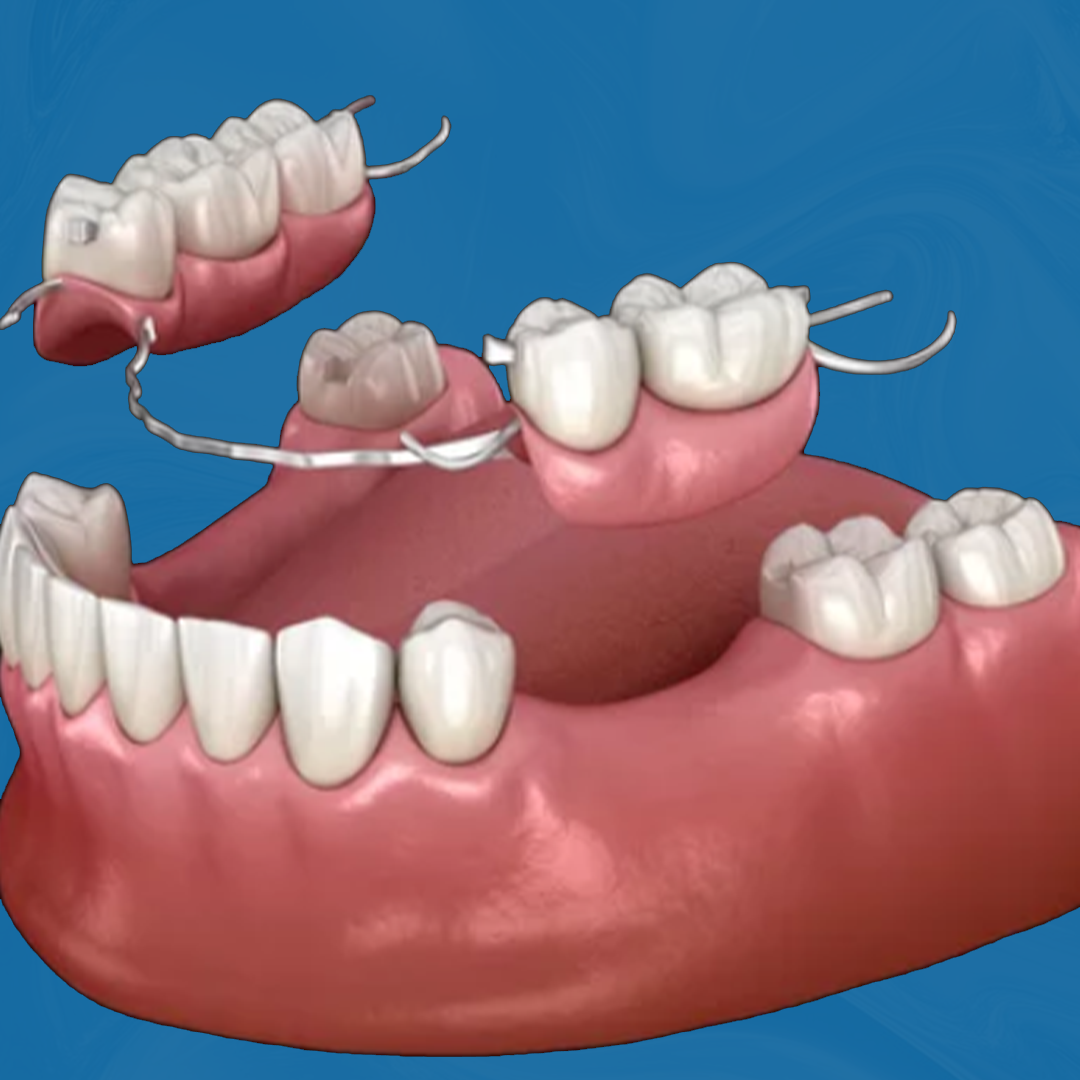 Repair of Dentures With Strengthener